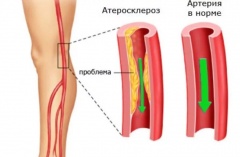  Атеросклероз сосудов нижних конечностей